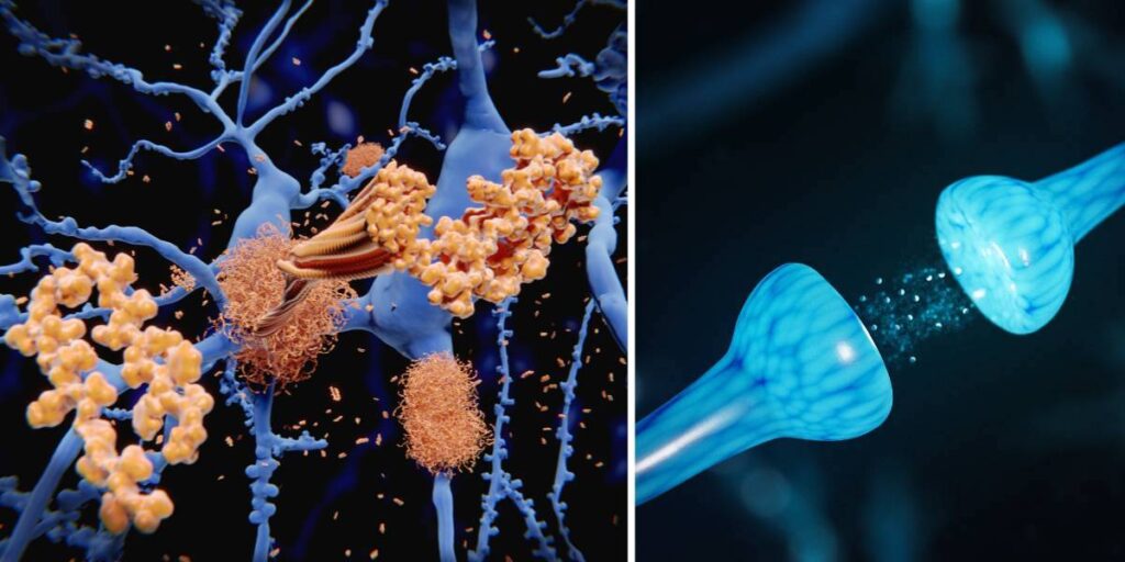 Vid Alzheimers sjukdom ansamlas amyloid-beta i hjärnan och bildar täta amyloidplack, vänster. Synaps, en nervcell skickar en signal till en annan nervcell, till höger